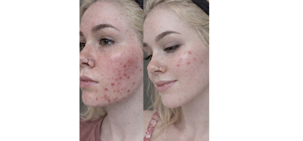 Why My Adult Acne Wasn’t a Skincare Problem and How Liver Support, Gut Health, and Hormones Were Connected